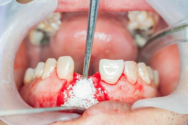 Bone Grafts in Dentistry: Supporting Stronger Foundations for Oral&nbsp;Health